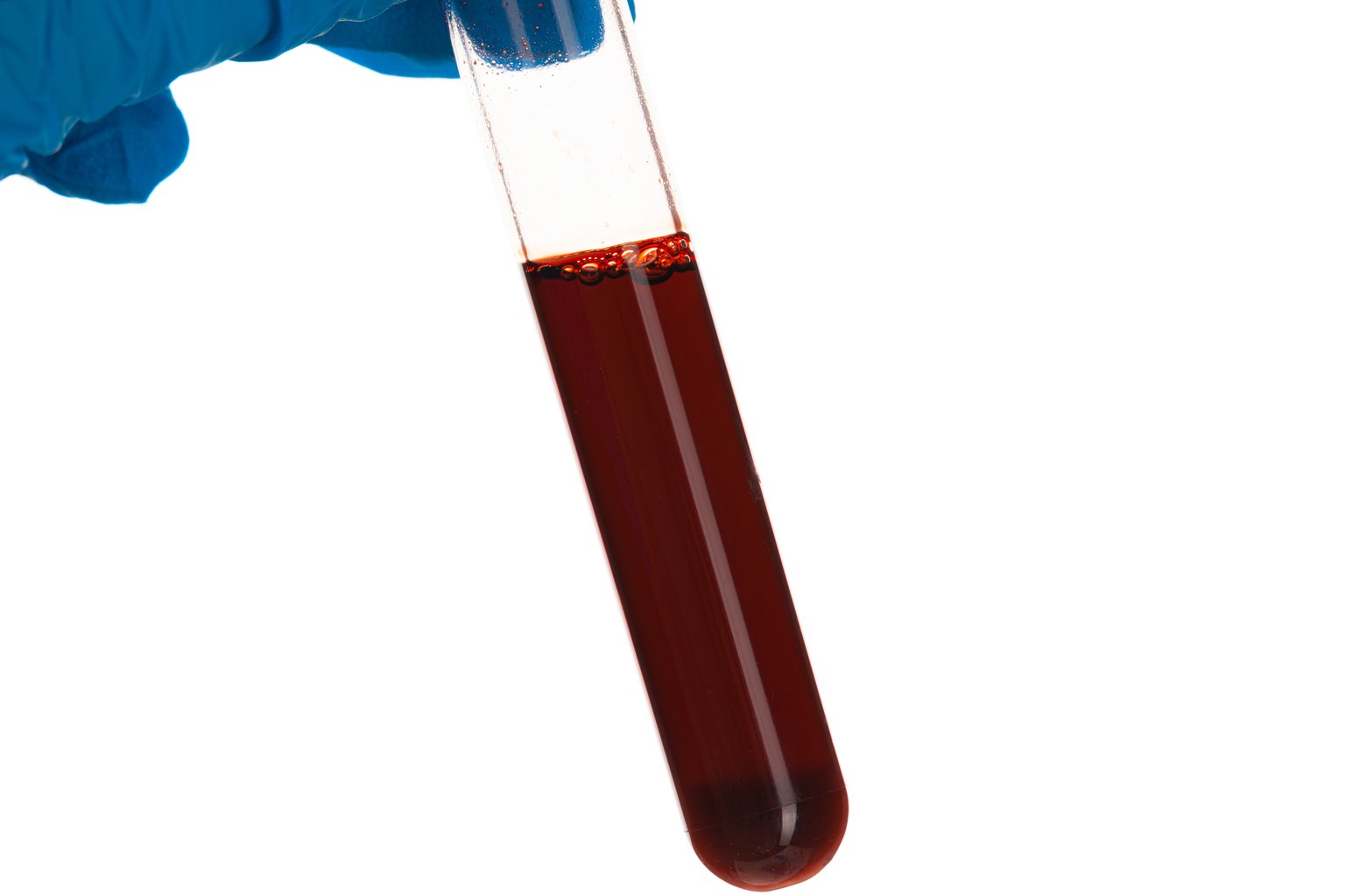 Tubo con muestra de sangre en una mano con guante, como la que se usa para obtener plasma rico en plaquetas